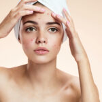 Hormonal Acne
