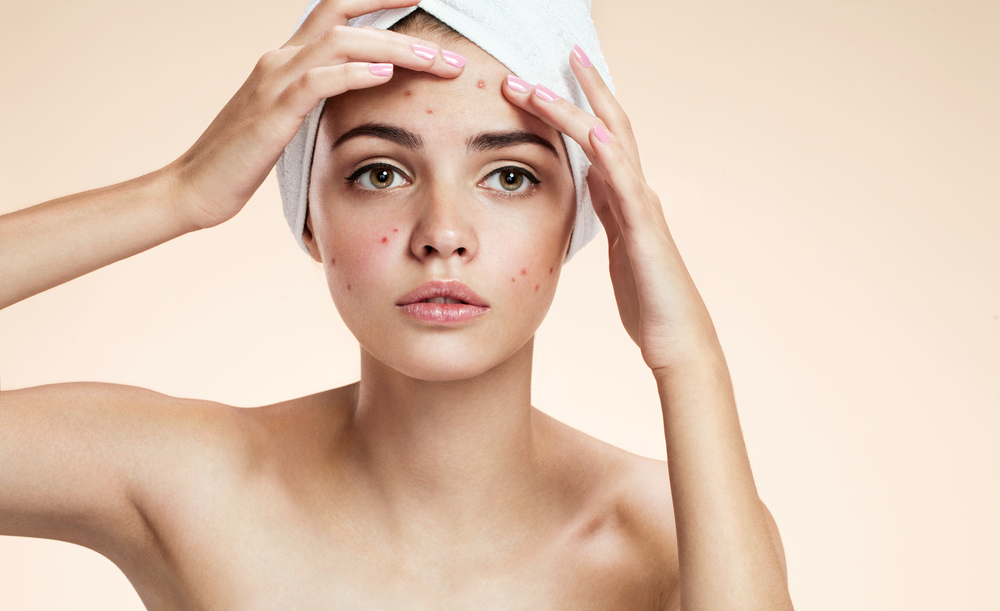 Hormonal Acne